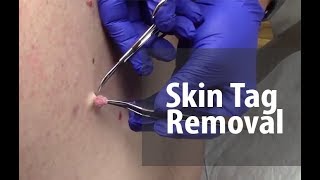 Remove papillomas skin