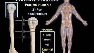 Fracture Fixation Animation - Everything You Need To Know - Dr. Nabil Ebraheim