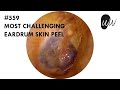 559 - Most Challenging Eardrum Skin Peel