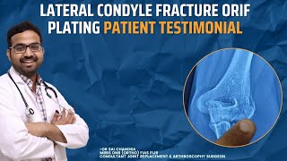 Lateral Condyle Fracture ORIF Plating Patient Testimonial #drsaichandra #saichandraortho
