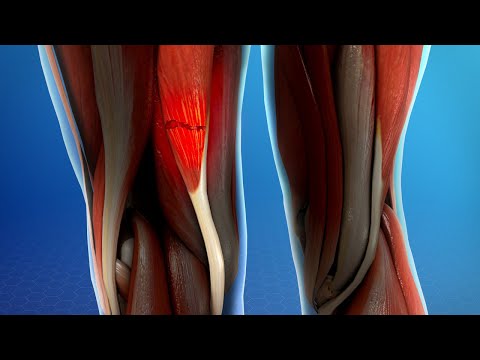 Hamstring Muscle Injuries