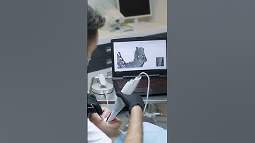 Dental digital impression, dental scanning 3shape for clear aligner, #intraoralscanning #tredding
