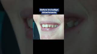 Proof That Invisalign is Much More Aesthetic Than Braces