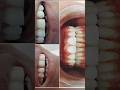 Composite Bonding #shortsfeed #arogyam #dentalclinic