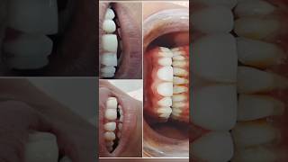 Composite Bonding #shortsfeed #arogyam #dentalclinic