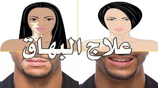 الفيتامينات التي تساعد مرضى البهاق  Vitamins For Vitiligo