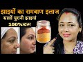 मेरी प्यारी Subscriber ने बताया उनकी सालों पुरानी झाइयां चली गई || Pigmentation Treatment