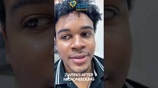 Microneedling #cosmeticsurgery #skincare #selfcare #medical #microneedling