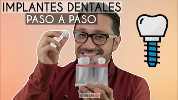 ¿Cómo sé qué tamaño de implante dental debo colocarme?