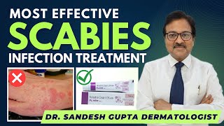 Scabies Treatment |Dr Sandesh Gupta, Dermatologist Delhi|9990804089