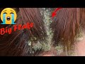 Itchy Dry Scalp!! Big Scratching Dandruff Satisfying And Picking Psoriasis