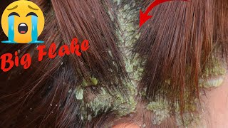 Itchy Dry Scalp!! Big Scratching Dandruff Satisfying And Picking Psoriasis