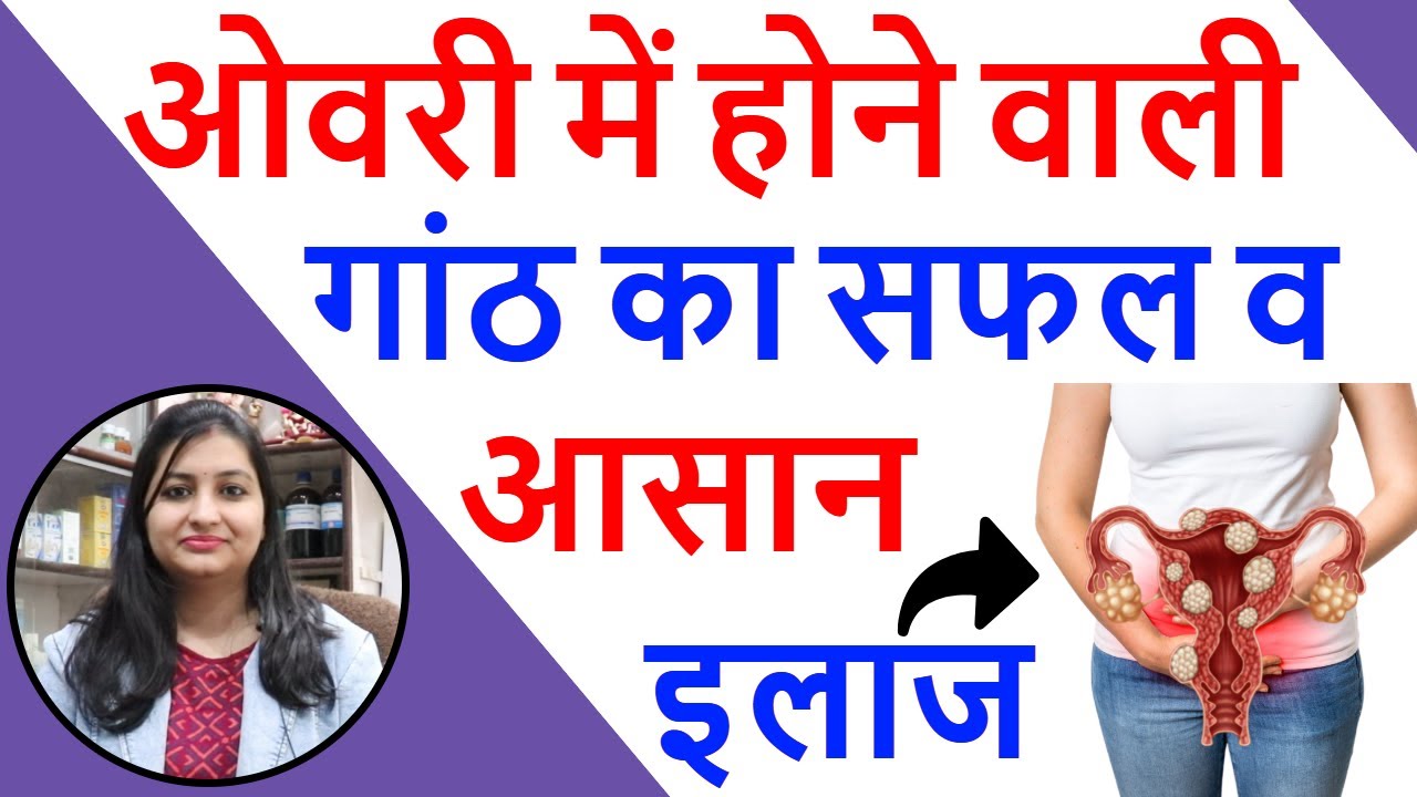 Ovarian cyst का सबसे अच्छी दवा Treatment Of Ovarian Cyst Best