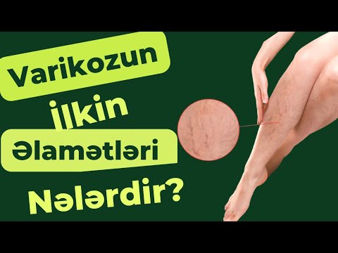 Video: Damar genişlənməsi nədir?