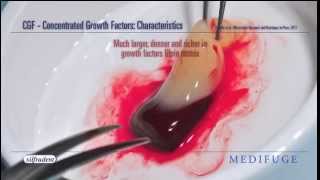 CGF - Concentrated Growth Factors with Medifuge
