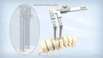 TSI QuickStart Distraction Screws