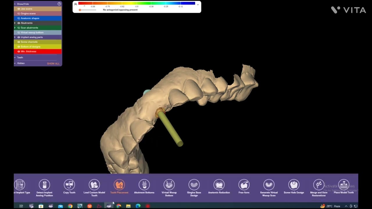 Implant Ti-base / zircon abutment / zircon crown Design One Time 🦷