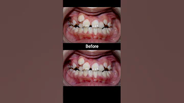 20 months Braces Transformation #braces #dentist #orthodontist #dental