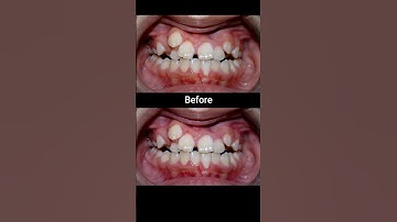 20 months Braces Transformation #braces #dentist #orthodontist #dental