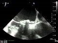 Ultrasept 30mm PFO TEE Picture
