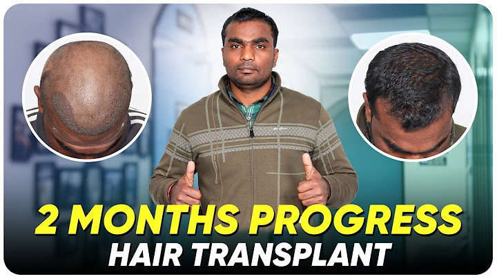 Hair transplant cost in bangalore reviews năm 2024