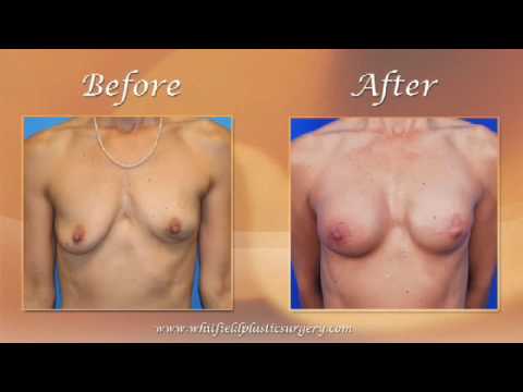 Reliable Breast Reconstruction Milwaukee, WI