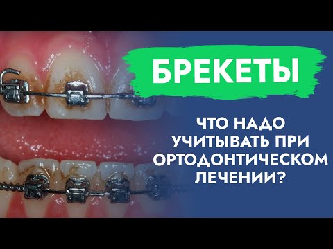 Брекеты. Что надо учитывать при ортодонтическом лечении?