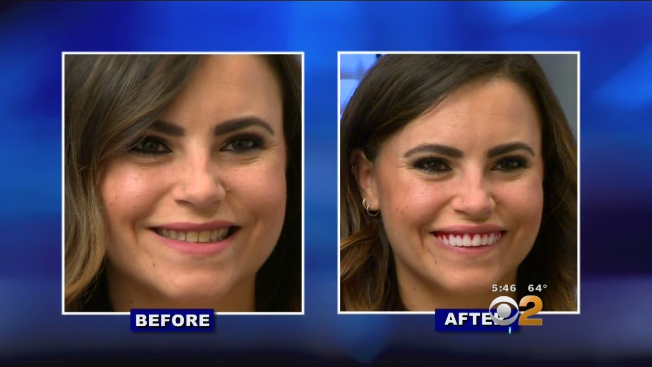 As Seen On TV: 'Perfect Smile Veneers' Not So Perfect