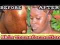 I CLEARED MY ACNE DARK SPOTS AND TEXTURED SKIN I JWILLSCOOL