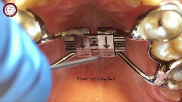 HYRAX  rapid palatal expansion activation in orthodontics by Dr. Amr Asker