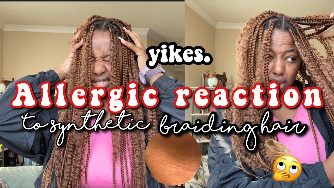 ALLERGIC REACTION TO SYNTHETIC BRAIDING HAIR!? Remedy+Relief YouTube