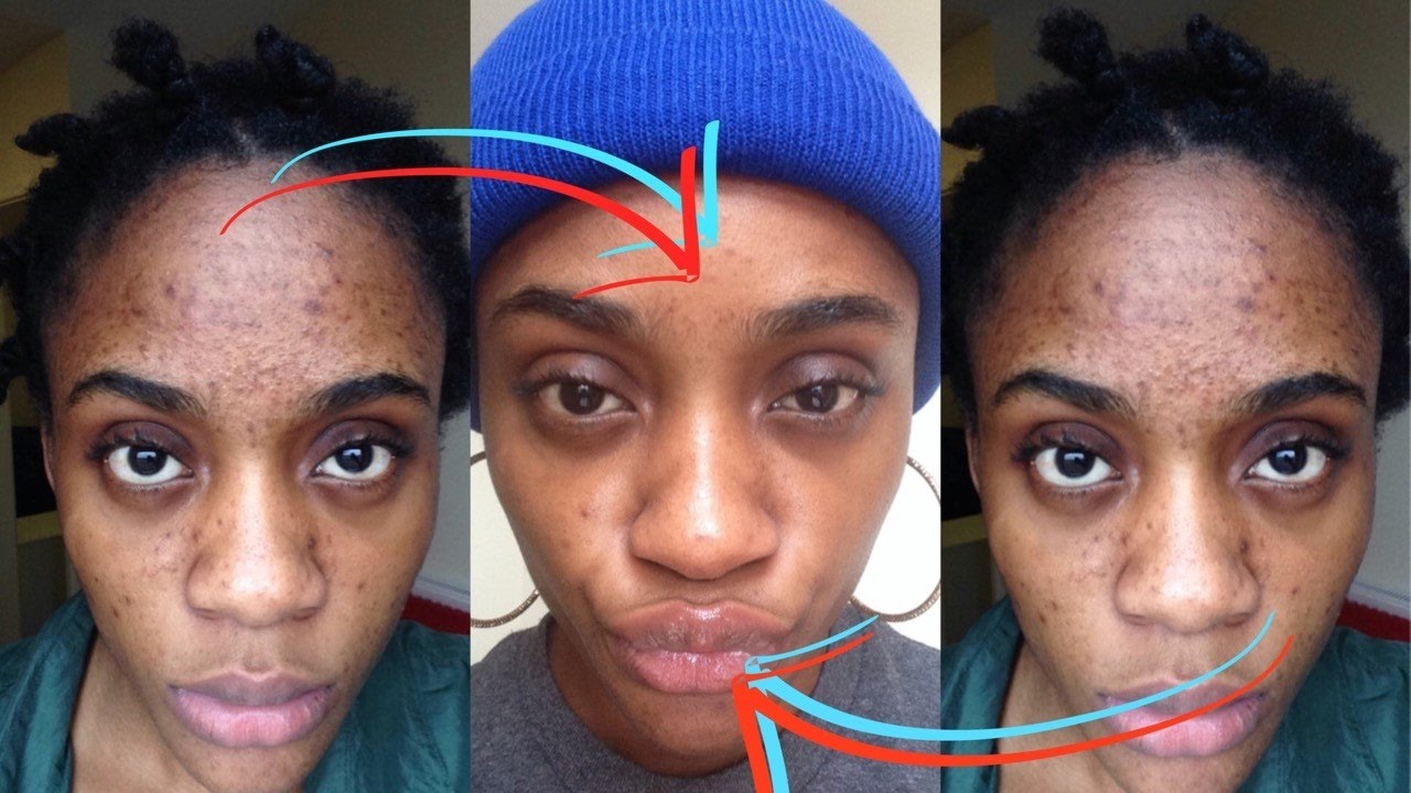 How I Got Rid of Dark Scars (Hyperpigmentation) & Acne! YouTube