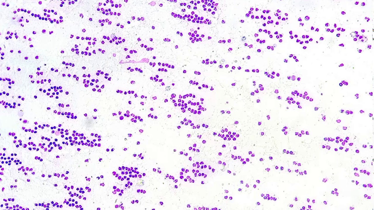Synovial fluid  | Windrowing | acute suppurative inflammation | immune mediated arthritis