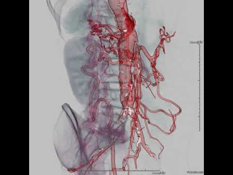 Mesenteric arterial insufficiency