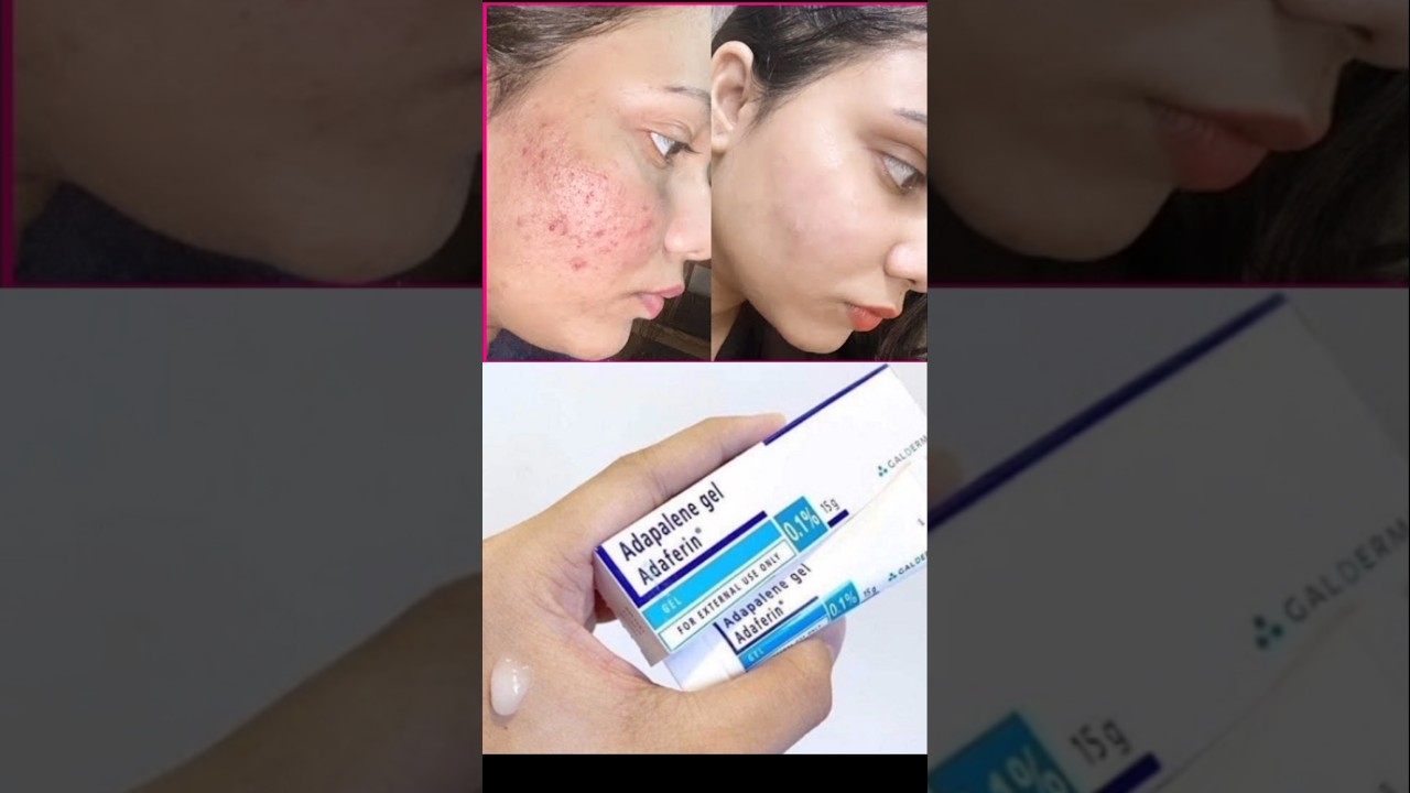 Adapalene Gel |Adapalene gel 0.1 |adapalene gelreview |Adaferin gel |Adaferin gel 0.1 reviews