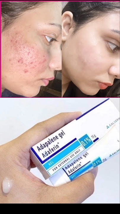 Adapalene Gel |Adapalene gel 0.1 |adapalene gelreview |Adaferin gel |Adaferin gel 0.1 reviews