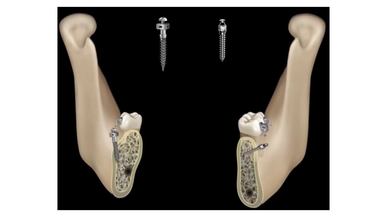 Correção da Classe III com parafusos extra alveolares (Shelf Mandibular)
