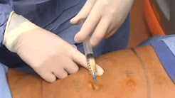 Atlanta Smartlipo: Laser Liposuction Demo by Dr. Jay Kulkin of WIFH