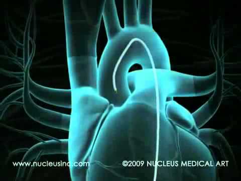 Angiography & Angioplasty Animation - YouTube