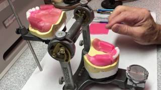 Posterior Denture Tooth Set-Up Lingualized Occlusion