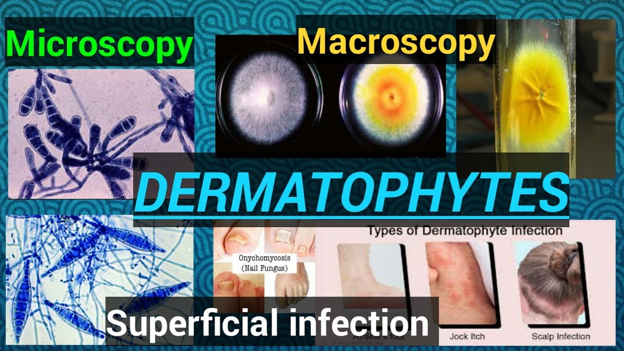 Fungal Infectionfungal Culturefungal Identificationdermatophytes