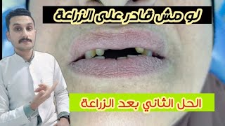 تركيب اسنان بورسلين قبل وبعد