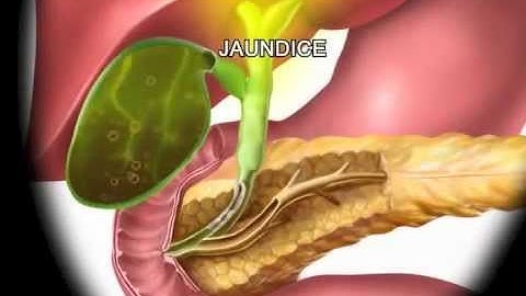 Common Duct Stricture - Meditoons™