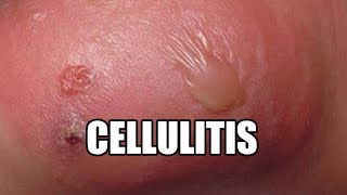 Cellulitis?  What is it?  Treatments, Causes and Symptoms!