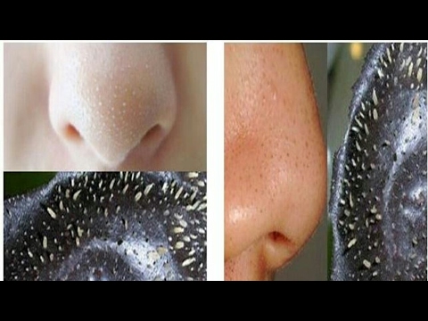 caseros remedios hemorroides Mascarilla para los puntos negros. Fácil y efectivo.