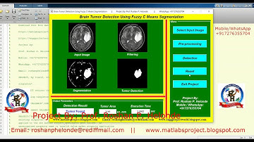 Brain Tumor Segmentation Using Fuzzy C Means Algorithm | Brain Tumor Detection Using Matlab Project