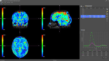 BrainMagix 2.0: DSC Perfusion MRI in a Brain Tumor