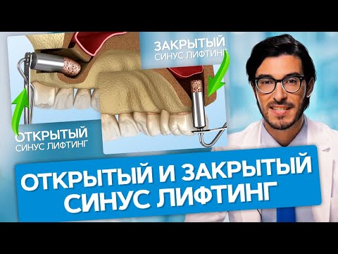 Открытый и закрытый синус лифтинг. В чем разница между открытым и закрытым синус лифтингом?