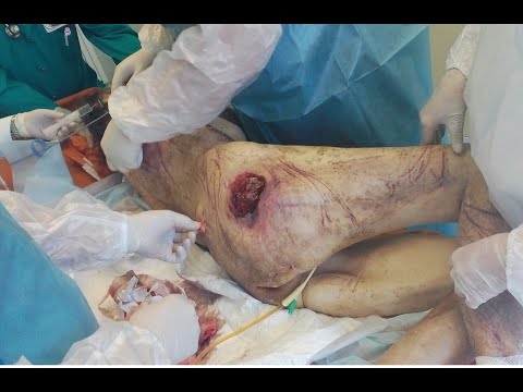 Multiple bedsores in a bedridden patient: necrectomy, wound dressing - #shorts