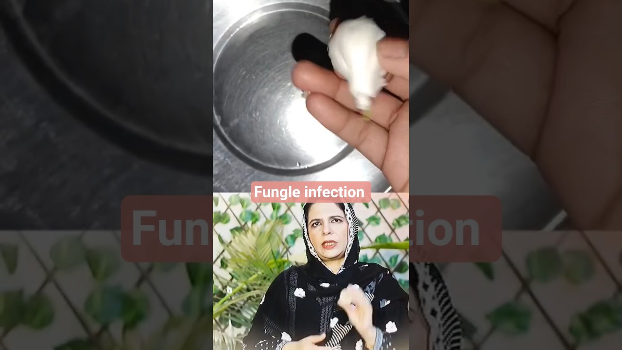 Fungle infection tretment 